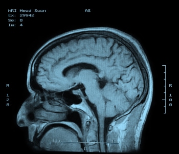 MRI image of the brain. MRI image of the brain.